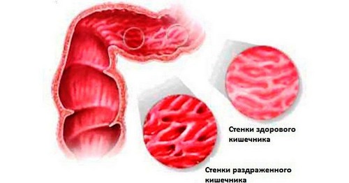 Що допоможе від кишкової інфекції. Яке лікування кишечника народними засобами вибрати