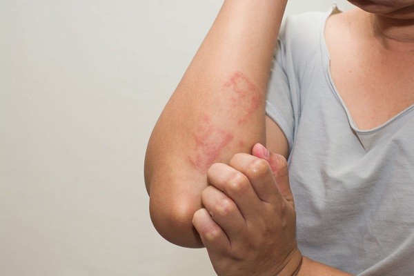 Atasi gatal alergi dengan 5 bahan alami ini